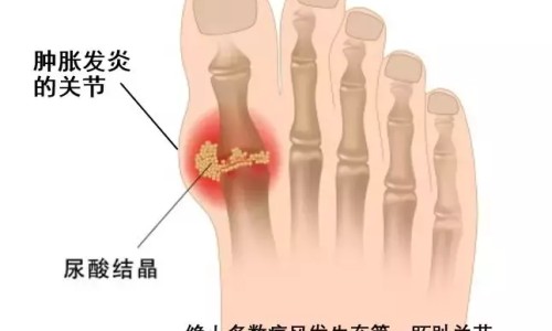 脑血栓病人吃钙片好不好-脑血栓病人吃钙片-专业脑血栓可以吃什么补品平台-脑血栓可以吃什么补品